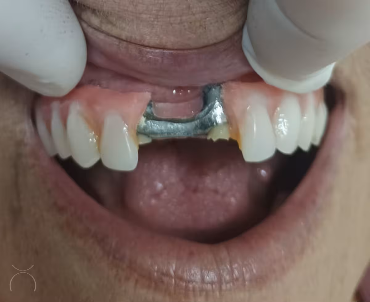 Barra metálica exposta em prótese protocolo após fratura do acrílico